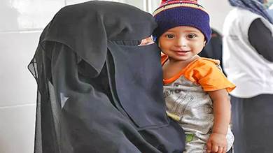 67 % من أطفال عمران اليمنية مصابون بسوء التغذية